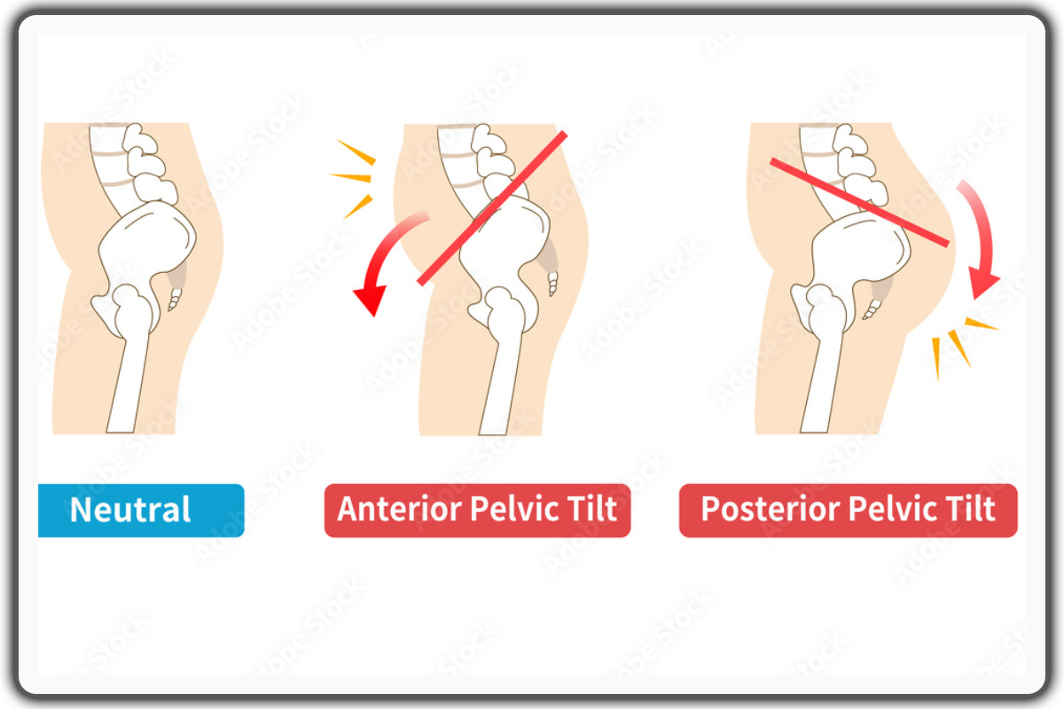 posterior pelvic tilt