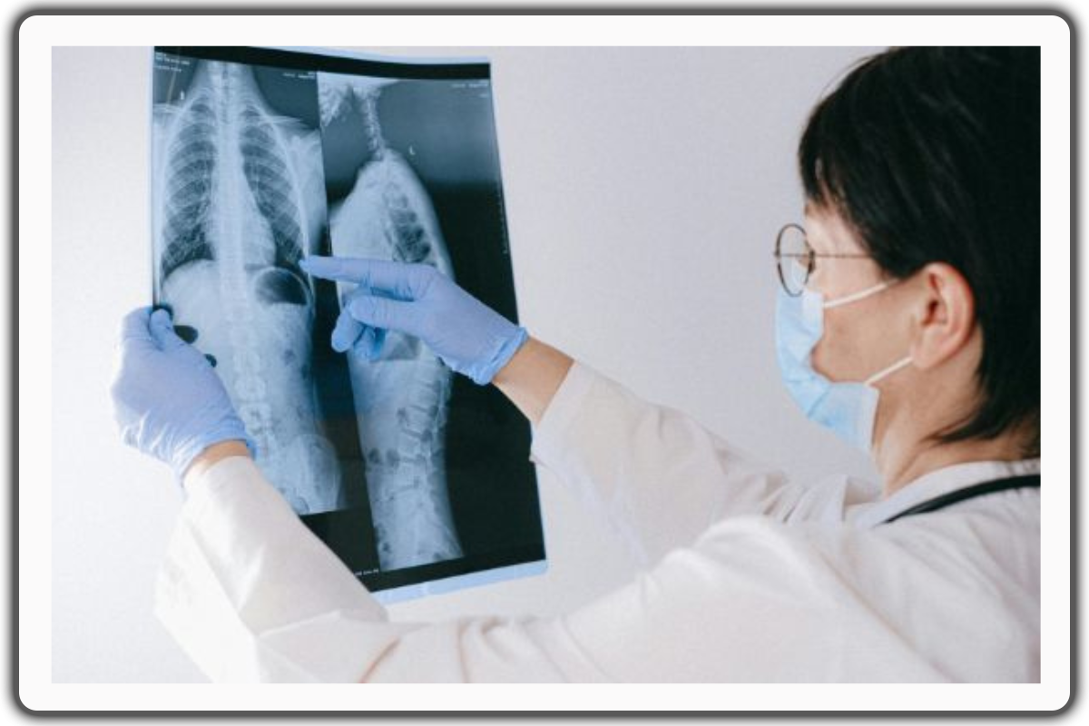 How to Identify Thoracic Spondylosis